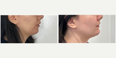 25-34 year old woman treated with Chin Filler - Patient was treated with hyaluronic acid filler to the chin to add shape and projection to the lower face. Results are immediate. Done by RN Cindy