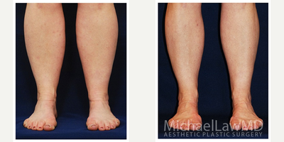 45-54 year old woman treated with Calf Reduction - Lower leg liposcution