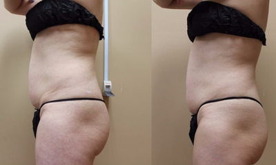 35-44 year old woman treated with UltraShape Power of the abdomen - This is a 44 year old female who exercises moderately and eats as healthy as she can. She had 4 children and wanted to lose the abdominal fat that she could never lose with dieting and exercise. She lost about 1.5 inches with three painless treatments. The addition of the Velashape III also helps with the skin tightening, a bonus not typically seen with other modalities.