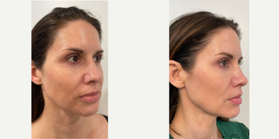 44 year old woman treated with Jet Peel - Brighter glowing skin after 4 customized JetPeel treatments