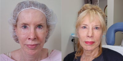 65-74 year old woman treated with Facelift Revision - The patient had the Bright Eyes MD procedure which consists of a mid-face (cheek) lift and a unique eyelid procedure that tucks the eye fat back under the eyes and secures it in place using the CPF fascia.