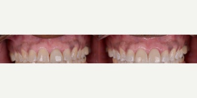 Woman treated with Gum Lift, Porcelain Veneers - Sometimes improve 2 front teeth is more difficult than 20, but we love the challenge