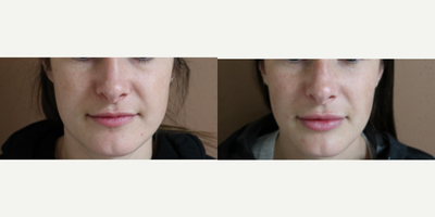 25-34 year old woman treated with Buccal Fat Removal - 9 months postoperative from buccal fat pad excision performed under local anesthesia in the office.