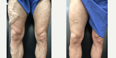 35-44 year old man treated with EVLT - Patient treated for refluxing varicose veins causing pain. Dr. Haney's treatment plan included a EVLT Laser Ablation, Phlebectomy and Sclerotherapy Injections. Tiny incision scars will fade quickly with time.