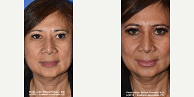 Woman treated with Cheek Implants - Woman treated with Cheek Implants