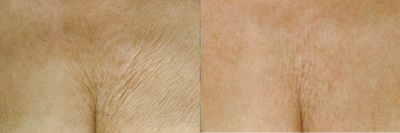 Affirm CO2 to Chest Area - 
	The Affirm CO2 utilizes an innovative fractional CO2 laser which creates tiny microscopic channels in the tissue so that new collagen can grow in to rejuvenate the skin.
