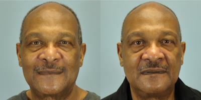 67 year old African American male treated with Rhinoplasty - This 67 year old patient underwent rhinoplasty - specifically, alar base resection done in the office while he was awake.