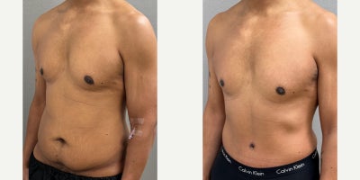 35-44 year old man treated with Male Tummy Tuck - 38 yo male s/p tummy tuck performed in our on site AAAA certified operating suite.