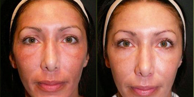 Woman treated with Pearl Laser - Pearl Laser