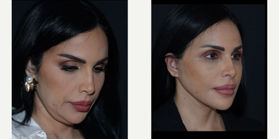 35-44 year old woman treated with Facelift, Facelift Revision, Neck Lift - 35-44 year old woman treated with Facelift