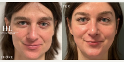 Woman treated with Jaw Reduction - Woman treated with Facial Feminization Surgery through Forehead Reduction (hairline advancement), Type 3 Brow Bone Reconstruction, direct Brow Lift, Cheek Augmentation using implants, Facelift, Jaw Reduction, Adam's Apple Reduction, Rhinoplasty, and a Subnasal Lip Lift. Patient is shown before and 6 months post-op.