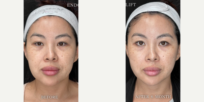 35-44 year old woman treated with Skin Tightening - Endolift for Facial Slimming