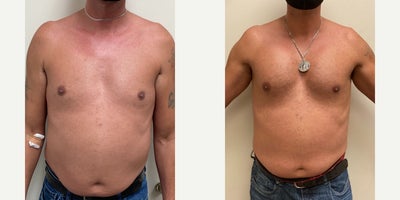 25-34 year old man treated with Pec Implants - Surgeon: Dr. AlexanderProcedure: Pec Implants