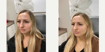 25-34 year old woman treated with Belotero - Tear trough filler with Dr. Wise to treat undereye hollowness