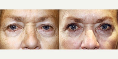 56 year old woman treated with Lower Blepharoplasty Surgery - 56 year old woman treated with Lower Blepharoplasty Surgery, giving the eyes a more youthful appearance.