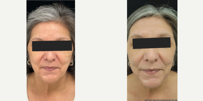 55-64 year old woman treated with AviClear - Things are coming along real nicely for our patient who decided to have our Tribella treatment. This is an hour and a half treatment that includes (1) IPL to address skin discolorations, (2) Skin tightening and lastly (3) Nano fractional resurfacing which addresses skin texture, pores and scars. There's clarity, softening, tightening and smoothing visible. A little more time and things will continue to get even better.