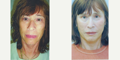 55-64 year old woman treated with Cheek Lift - Patient was treated with Cheek Lift