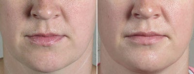 35 Year Old Female Lip Enhancement - This 35 year old existing patient of Dr. Parker asked him to insert silicone implants in her lips to create more long-lasting fullness. She said over time her lips have become smaller. Dr. Parker performed the procedure under local anesthesia, inserting the implants into both the upper and lower lips through an inconspicuous tiny incision in the corner of the mouth.&nbsp;