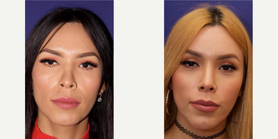 Facial Feminization Surgery - Facial Feminization Surgery