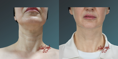 35-44 year old woman treated with Thermage FLX - 35-44 year old woman treated with Thermage FLX