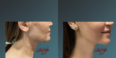 35-44 year old woman treated with Thermage FLX - 35-44 year old woman treated with Thermage FLX