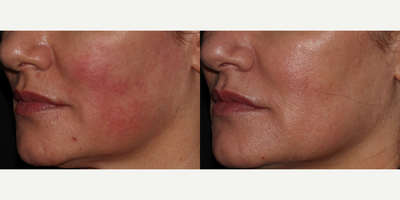 45-54 year old woman treated with Laser Genesis, Excel V - Patient was treated with laser treatments to clear up skin and treat rosacea / redness.