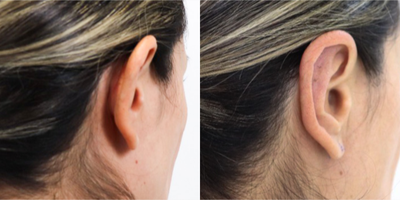 25-34 year old woman treated with Ear Surgery - In my technique, the cartilage is rearranged in the back, or in the posterior part of the ear called the mastoid.