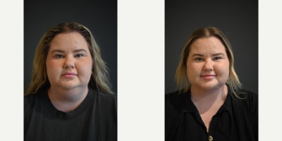 25-34 year old woman treated with Neck Lift - 25-34 year old woman treated with Neck Lift