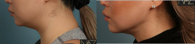 45-54 year old woman treated with Neck Lift - Neck lift-MyEllevate.