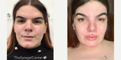 25-34 year old transgender woman treated with Transgender Facial Feminization Surgery - 25-34 year old transgender woman treated with Transgender Facial Feminization Surgery