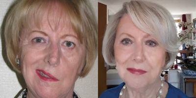 65-74 year old woman treated with Ellanse - This lady had an acoustic neuroma removed, during surgery her facial nerve was cut and she was left with a severe facial palsy and asymmetry. She underwent a combination treatment of Ellanse dermal filler to volumise her midface and a Silhouette Soft suture to lift her brow. The treatment was phased over a 3 month period.A total of 6mls of the collagen stimulatory filler Ellanse was used to create this beautiful result.
