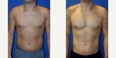 25-34 year old man treated with Pec Implants, Liposculpture, Liposuction - 32 year old male from Miami, Florida 9 months after pec implants and liposculpture performed by Dr Sam Gershenbaum. He had vertical-rectangular implants placed under the muscle, size 2, and liposculpture of his gynecomastia, abdomen and waist areas. His body has been transformed !