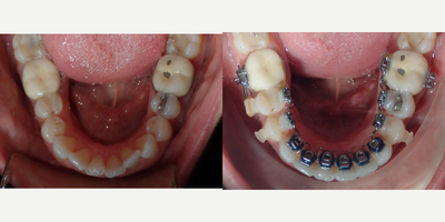 55-64 year old woman treated with InBrace - This is a 6 month progress of patients lower teeth. Treated with Inbrace.