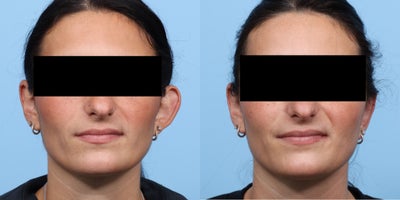 25-34 year old woman treated with Ear Surgery - Dr. Wise performed a unilateral otoplasty on this patient to correct the protrusion of her one ear.