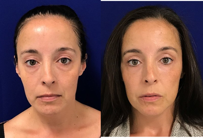 35-44 year old woman treated with Belotero - Undereye and cheek filler transformation on my 37 years young patient! I placed one syringe of Belotero in the tear trough area, 2 syringes of Voluma into the cheeks and Botox around her eyes. Here she is 2 weeks post Injections.