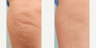 Woman treated with Cellulaze - Woman treated with Cellulaze