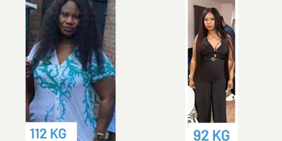 25-34 year old woman treated with Gastric Balloon - This beautiful patient came to us to lose weight, and was very happy with the result thanks to our gastric balloon treatment