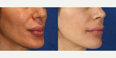 Foreign Body Lip Injection Removal After Illegal Permanent Filler Injections - Permanent lip fillers can become a serious problem when they cause pain, burning, and changes in the way the lips look and feel. Our patient is a 41-year-old White female who sought Dr. J. Timothy Katzen after having permanent filler placed illegally into both the upper and lower lips 20 years ago by an aesthetician in Germany. She had been told the product was a biopolymer. Years later, she began experiencing burning sensations in her lips and wanted the product removed before the problem worsened. Dr. Katzen recommended lip foreign-body injection removal to remove the permanent filler and the tissue affected by it. Under general anesthesia, he carefully opened the lips and removed the abnormal material from both the upper and lower lips. Lip foreign body removal is often needed when permanent fillers harden, irritate the tissue, or create an unnatural contour. Unlike temporary fillers, permanent products can remain in the lips for years and continue causing symptoms. The goal of surgery is to remove the foreign material, improve comfort, and help restore a more natural lip shape. These photos were taken 1 week after surgery and already show our patients remarkable result. Her case demonstrates Dr. Katzens expertise in lip filler removal surgery, permanent filler removal, and foreign body removal of the lips for symptomatic biopolymer injections. Early healing already suggests a softer texture, better contour, and improved comfort.