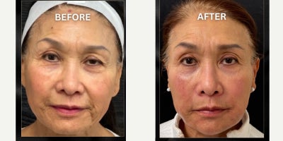 65-74 year old woman treated with Nonsurgical Facelift - These pictures are before and after 4 sessions of 7D Fotona facelift ( my signature procedure) and Hyperdilute Radiesse injection ( biostimulator) in the face. Pay attention specifically to the eyelids ( non surgical blepharoplasty)