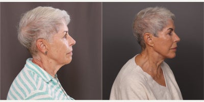 75 and up year old woman treated with Facelift, Double Eyelid Surgery, Facial Fat Transfer, Botox, Dermal Fillers, Laser Resurfa - Facelift, Upper & Lower Blepharoplasty, Fat Grafting by Dr. Thompson. Contour TRL, Botox, Dermal Fillers, and Hydrafacial. 3 years post-operative.