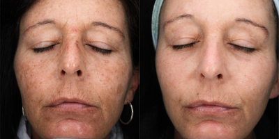 45-54 year old woman treated with Pico Genesis - Patient wanted sun spots to dissipate and to refreshen the skin.