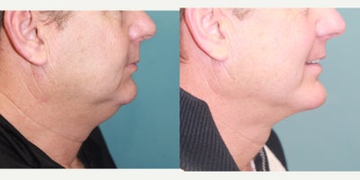 45-54 year old man treated with Chin Implant - Patient had extended anatomical chin implant placed and neck liposuction