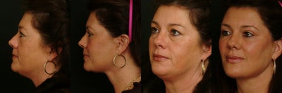 Deep Plane Lower Face Lift  - Patient had a Deep Plane Lower Facelift to correct her neck, jowls and marionette lines.  She also had an Upper and Lower Blepharoplasty and a Midface Fat Transfer