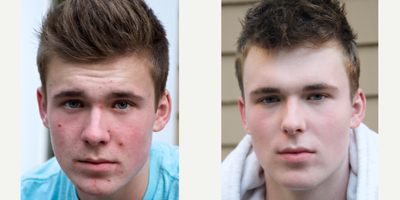 17 or under year old man treated with Accutane - Patient with history of recalcitrant acne, treated successfully with isotretinoin. Photos are untouched.