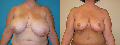Breast Reduction  - 
	Breast Reduction
