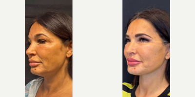Woman treated with Lower Facelift - Woman treated with Deep Plane Facelift to lower face and Neck Lift. Patient is shown before and 6 weeks post-op.