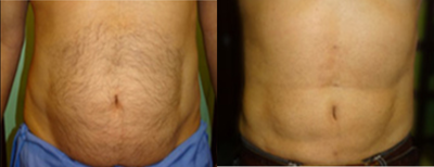 35-44 year old man treated with Liposuction - 44 year old male had Water Jet Liposuction.