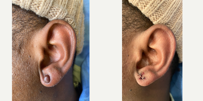 25-34 year old man treated with Biocorneum - Male patient with keloid on the earlobe treated with a combination of surgery repair, and Plato's Scar Serum.