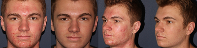 Photodynamic Therapy for Acne Treatment  - Young male patient with severe acne is treated with Photodynamic Therapy and sees amazing improvement after only one treatment.