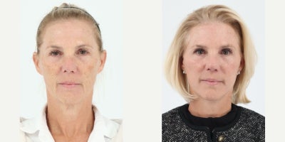 55-64 year old woman treated with Facelift, Neck Lift, Facial Fat Transfer - 58 year old patient is 2 months after Facelift, Neck lift and Facial Fat Transfer done with local anesthesia by Dr. Dilip D. Madnani.